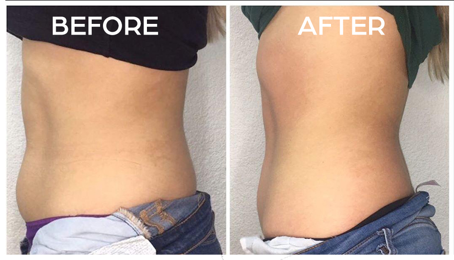 Body Contouring Before and After, Real Results